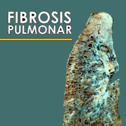 Fibrosis pulmonar