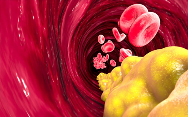 Glóbulos rojos y colesterol LDL